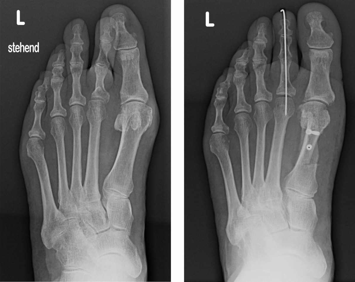 Vorfussdeformität mit Hallux valgus und fixierter Hammerzehe II - Röntgenbild vor und nach Korrektur